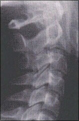 Normal Cervical Curve X-ray